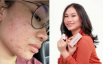 431384-Before_and_after_of_Adibah_Mazlan_who_used_her_own_products_for_three_months_to_clear_her_skin